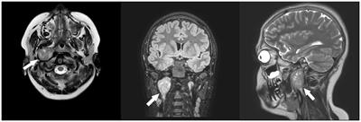 Pediatric schwannoma of the hypoglossal nerve: a case report and narrative literature overview